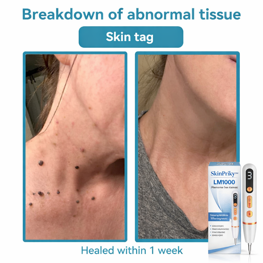 ✨SkinPrikyn™ Whitening mole and freckle removal pen, scarless spot removal device, picosecond laser mole removal, salon-grade beauty device, home beauty device.