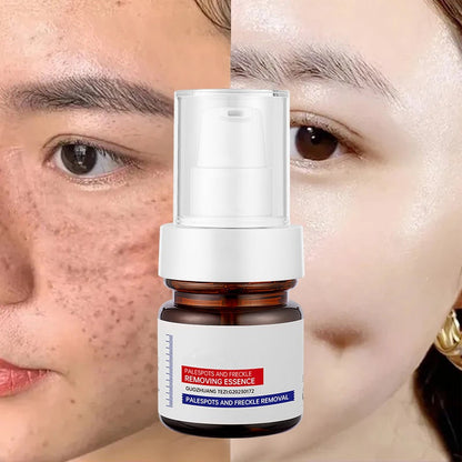 Dark Spot Remover for Face & Body | Advanced Corrector Serum for Age, Melasma, Sun, Acne, Black Spots | Tranexamic Acid, Niacinamide Formula for Women & Men Big Sale