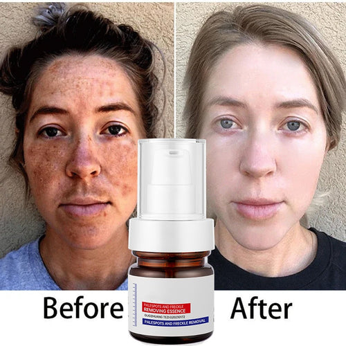 Dark Spot Remover for Face & Body | Advanced Corrector Serum for Age, Melasma, Sun, Acne, Black Spots | Tranexamic Acid, Niacinamide Formula for Women & Men Big Sale