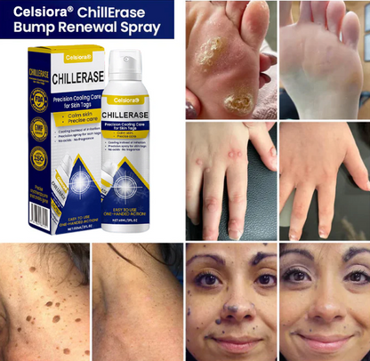 🇺🇸❄️ Celsiora® ChillErase Cooling Spray for Skin Tags