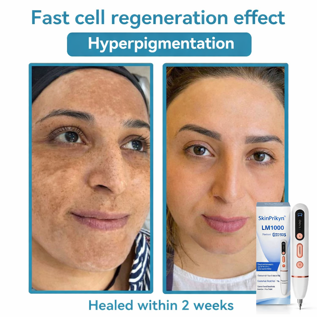 ✨SkinPrikyn™ Whitening mole and freckle removal pen, scarless spot removal device, picosecond laser mole removal, salon-grade beauty device, home beauty device.