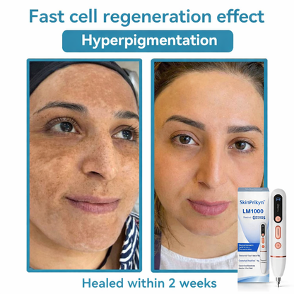 ✨SkinPrikyn™ Whitening mole and freckle removal pen, scarless spot removal device, picosecond laser mole removal, salon-grade beauty device, home beauty device.