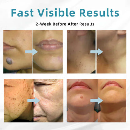 ✨VelvetSkin+™ All-in-One CO₂ Laser Eraser Pen | Removes Moles, Warts, Skin Flaws & Pigmentation Big Sale