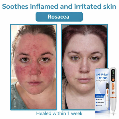 ✨SkinPrikyn™ Whitening mole and freckle removal pen, scarless spot removal device, picosecond laser mole removal, salon-grade beauty device, home beauty device.