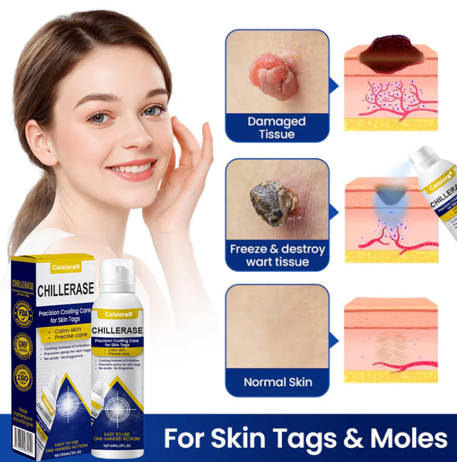 🇺🇸❄️ Celsiora® ChillErase Cooling Spray for Skin Tags