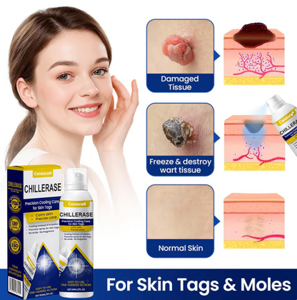 🇺🇸❄️ Celsiora® ChillErase Cooling Spray for Skin Tags