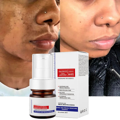 Dark Spot Remover for Face & Body | Advanced Corrector Serum for Age, Melasma, Sun, Acne, Black Spots | Tranexamic Acid, Niacinamide Formula for Women & Men Big Sale