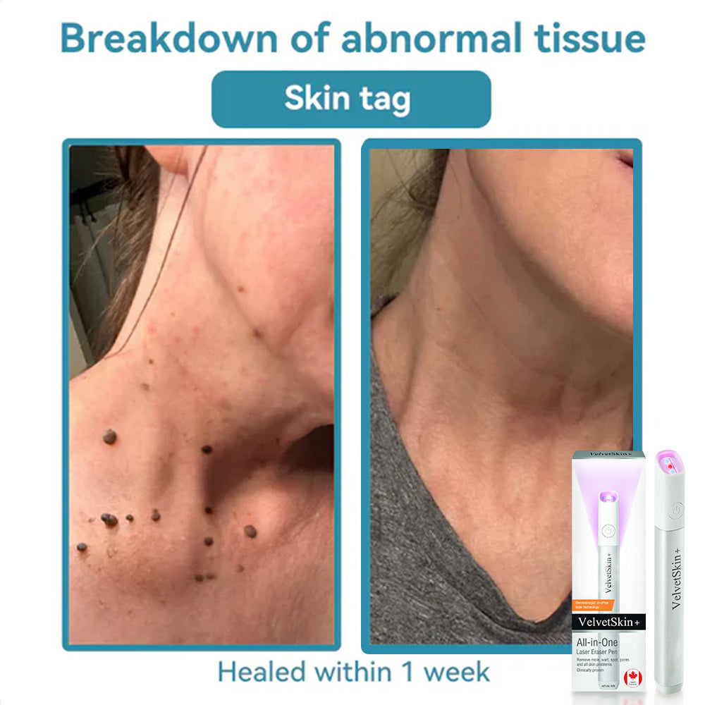✨VelvetSkin+™ All-in-One CO₂ Laser Eraser Pen | Removes Moles, Warts, Skin Flaws & Pigmentation Big Sale
