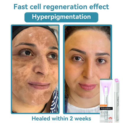 ✨VelvetSkin+™ All-in-One CO₂ Laser Eraser Pen | Removes Moles, Warts, Skin Flaws & Pigmentation Big Sale