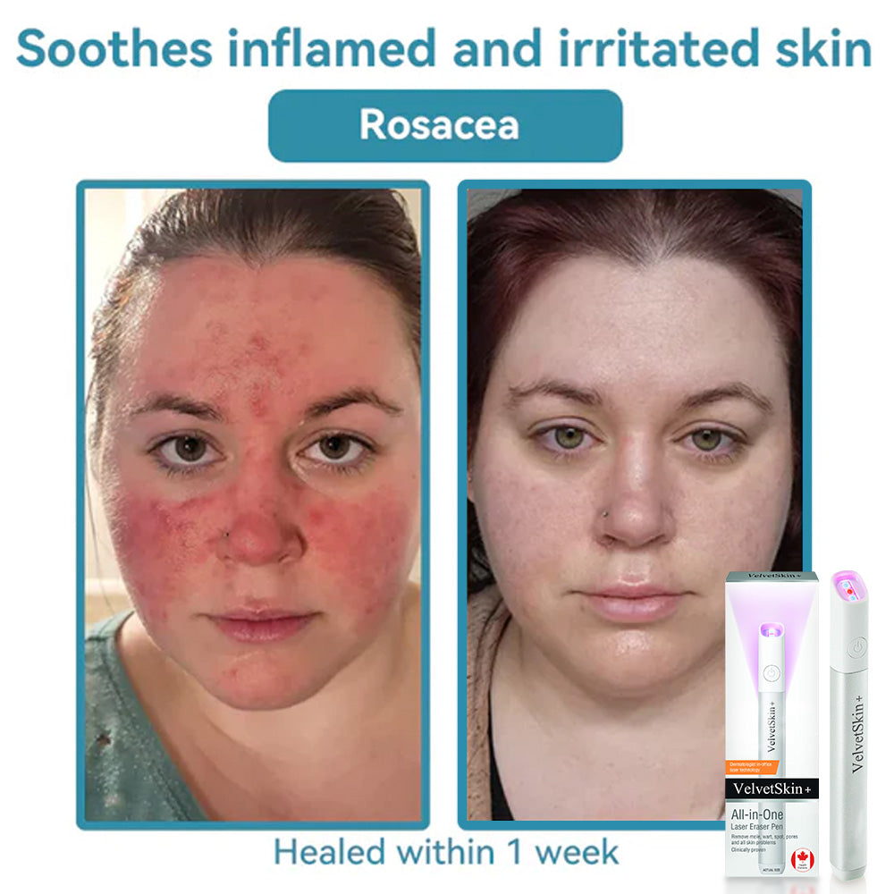 ✨VelvetSkin+™ All-in-One CO₂ Laser Eraser Pen | Removes Moles, Warts, Skin Flaws & Pigmentation Big Sale