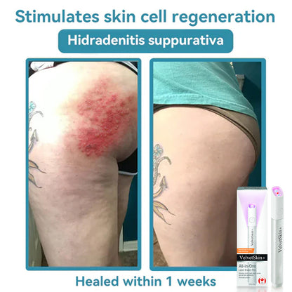 ✨VelvetSkin+™ All-in-One CO₂ Laser Eraser Pen | Removes Moles, Warts, Skin Flaws & Pigmentation Big Sale